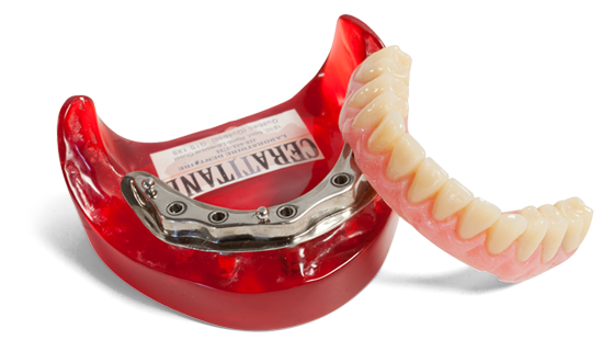Prothèses dentaires sur implants
